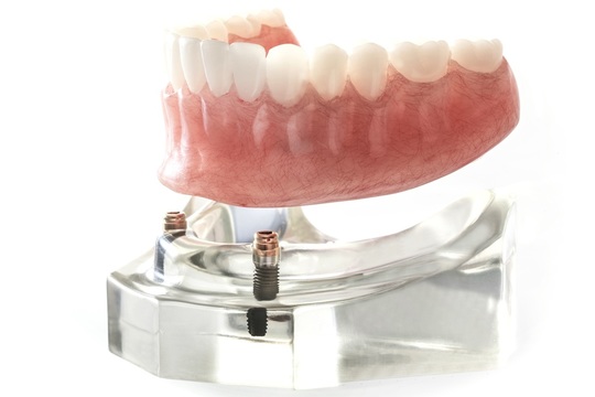 入れ歯（義歯）の治療 - 塚口むらうち歯科矯正歯科クリニック（塚口